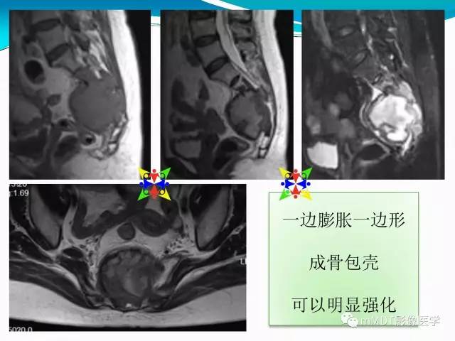 【PPT】骶尾椎病变的诊断思路