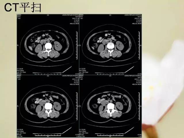 【病例】胃肠道间质瘤1例影像诊断与鉴别 【病例】胃肠道间质瘤1例影像诊断与鉴别