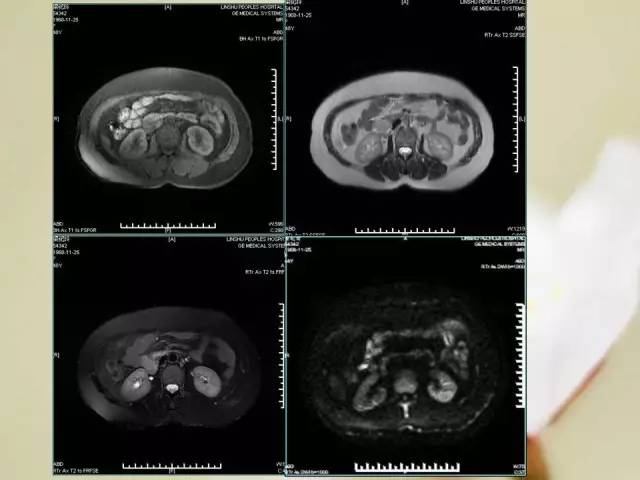 【病例】胃肠道间质瘤1例影像诊断与鉴别 【病例】胃肠道间质瘤1例影像诊断与鉴别