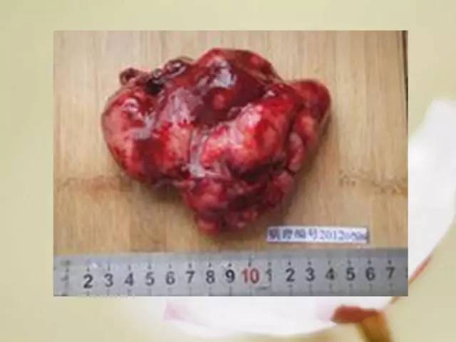 【病例】胃肠道间质瘤1例影像诊断与鉴别 【病例】胃肠道间质瘤1例影像诊断与鉴别