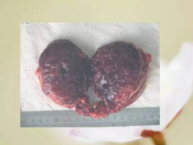 【病例】胃肠道间质瘤1例影像诊断与鉴别 【病例】胃肠道间质瘤1例影像诊断与鉴别