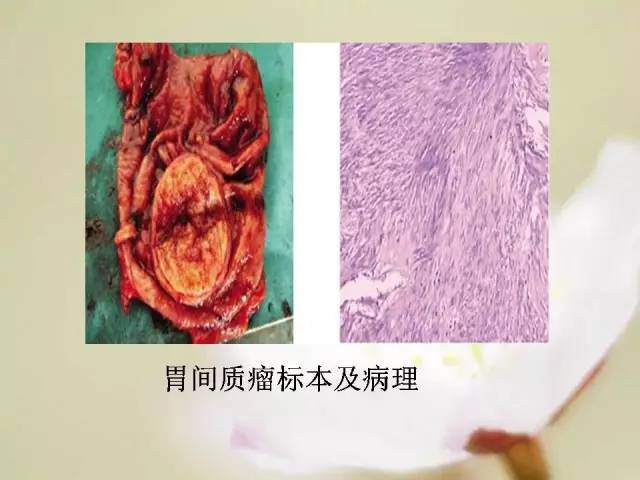【病例】胃肠道间质瘤1例影像诊断与鉴别 【病例】胃肠道间质瘤1例影像诊断与鉴别