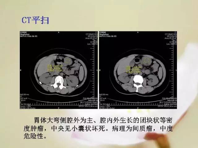 【病例】胃肠道间质瘤1例影像诊断与鉴别 【病例】胃肠道间质瘤1例影像诊断与鉴别