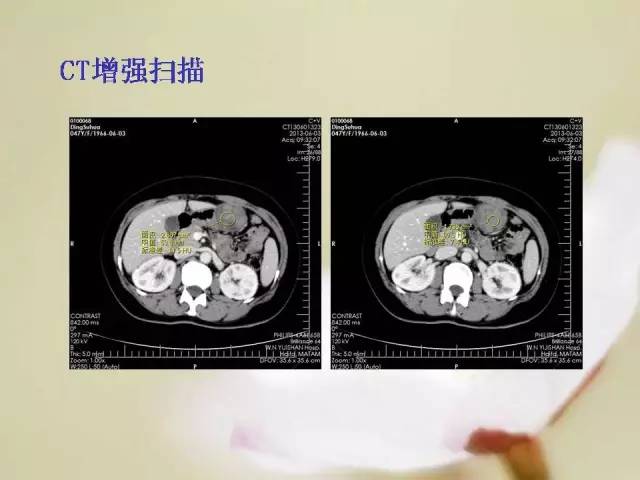 【病例】胃肠道间质瘤1例影像诊断与鉴别 【病例】胃肠道间质瘤1例影像诊断与鉴别