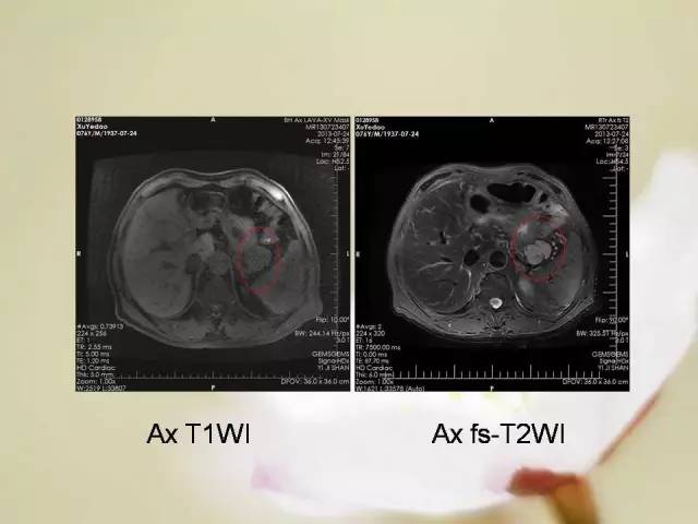 【病例】胃肠道间质瘤1例影像诊断与鉴别 【病例】胃肠道间质瘤1例影像诊断与鉴别