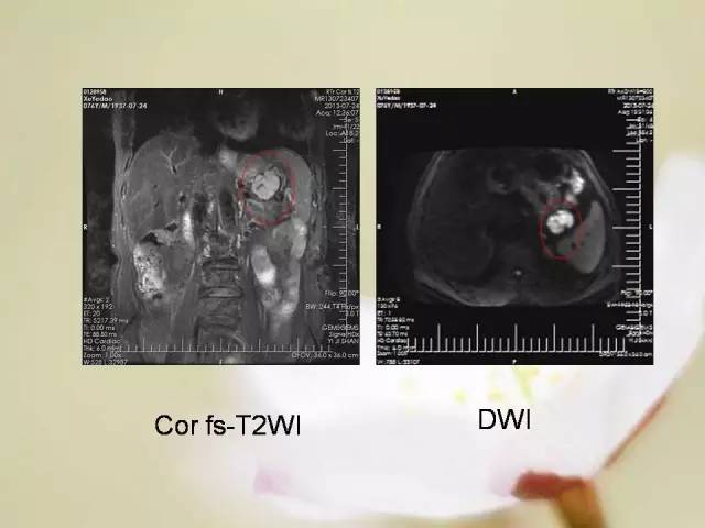 【病例】胃肠道间质瘤1例影像诊断与鉴别 【病例】胃肠道间质瘤1例影像诊断与鉴别