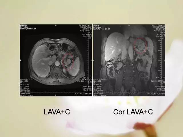 【病例】胃肠道间质瘤1例影像诊断与鉴别 【病例】胃肠道间质瘤1例影像诊断与鉴别
