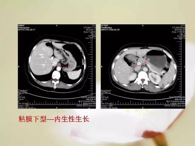 【病例】胃肠道间质瘤1例影像诊断与鉴别 【病例】胃肠道间质瘤1例影像诊断与鉴别