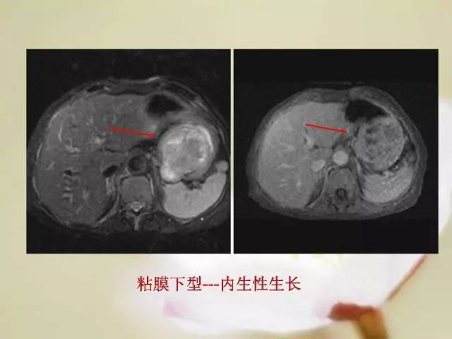 【病例】胃肠道间质瘤1例影像诊断与鉴别 【病例】胃肠道间质瘤1例影像诊断与鉴别