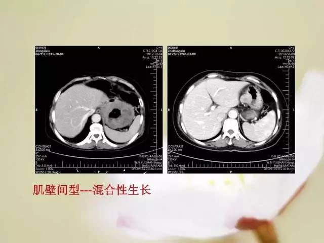 【病例】胃肠道间质瘤1例影像诊断与鉴别 【病例】胃肠道间质瘤1例影像诊断与鉴别
