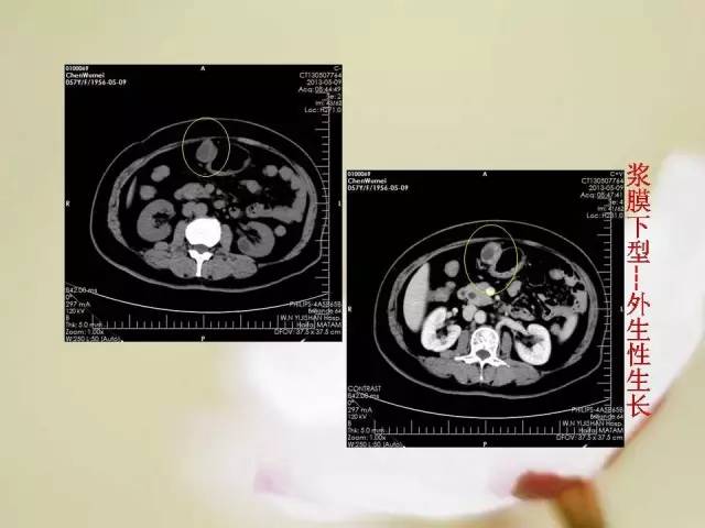【病例】胃肠道间质瘤1例影像诊断与鉴别 【病例】胃肠道间质瘤1例影像诊断与鉴别