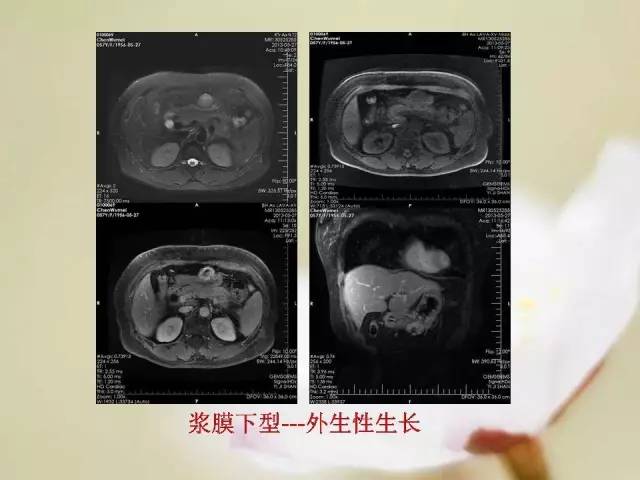 【病例】胃肠道间质瘤1例影像诊断与鉴别 【病例】胃肠道间质瘤1例影像诊断与鉴别