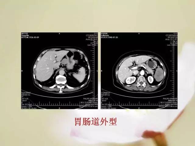 【病例】胃肠道间质瘤1例影像诊断与鉴别 【病例】胃肠道间质瘤1例影像诊断与鉴别