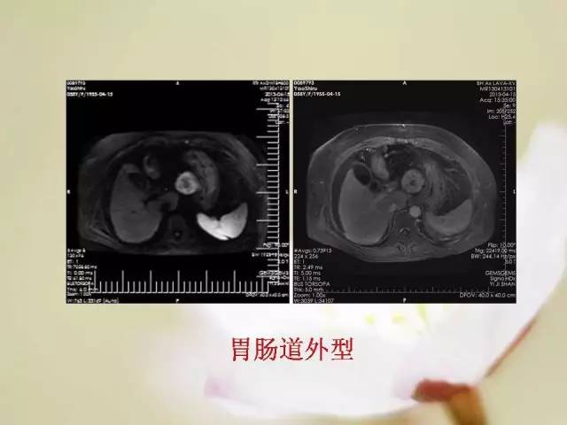 【病例】胃肠道间质瘤1例影像诊断与鉴别 【病例】胃肠道间质瘤1例影像诊断与鉴别
