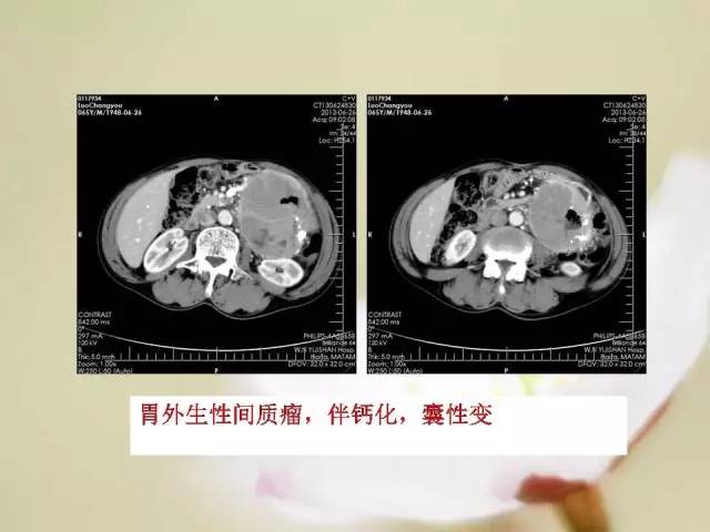 【病例】胃肠道间质瘤1例影像诊断与鉴别 【病例】胃肠道间质瘤1例影像诊断与鉴别