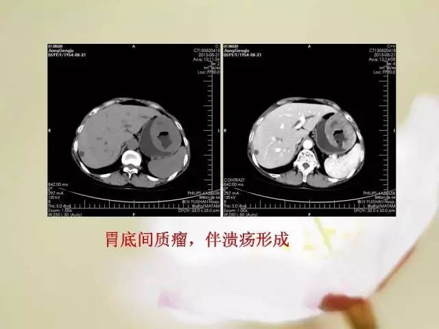 【病例】胃肠道间质瘤1例影像诊断与鉴别 【病例】胃肠道间质瘤1例影像诊断与鉴别