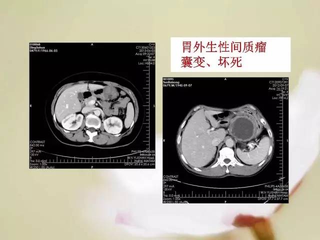 【病例】胃肠道间质瘤1例影像诊断与鉴别 【病例】胃肠道间质瘤1例影像诊断与鉴别