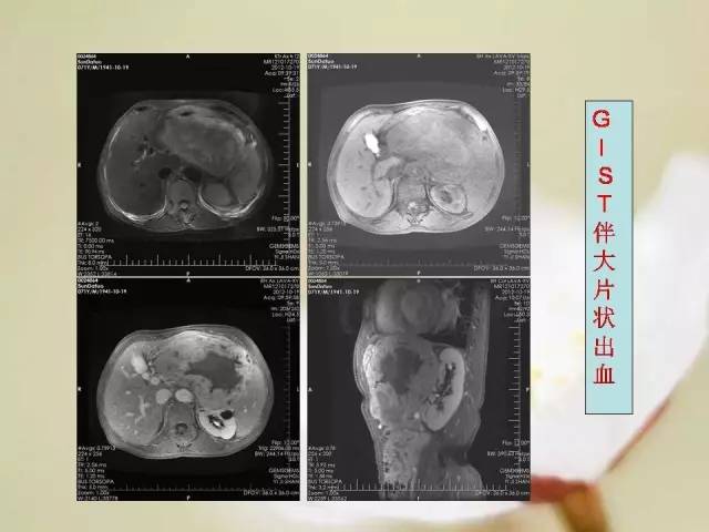 【病例】胃肠道间质瘤1例影像诊断与鉴别 【病例】胃肠道间质瘤1例影像诊断与鉴别