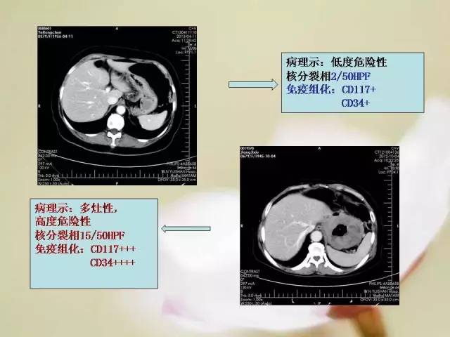 【病例】胃肠道间质瘤1例影像诊断与鉴别 【病例】胃肠道间质瘤1例影像诊断与鉴别