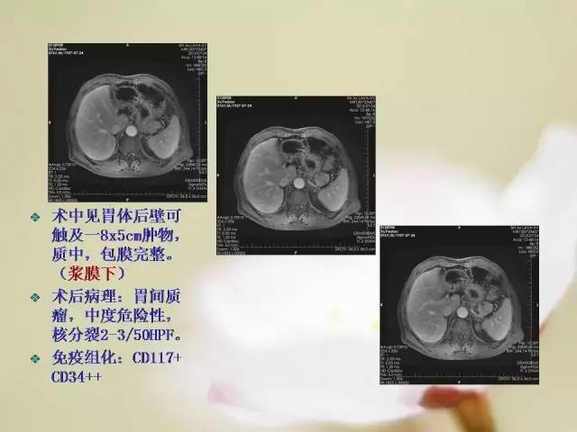 【病例】胃肠道间质瘤1例影像诊断与鉴别 【病例】胃肠道间质瘤1例影像诊断与鉴别