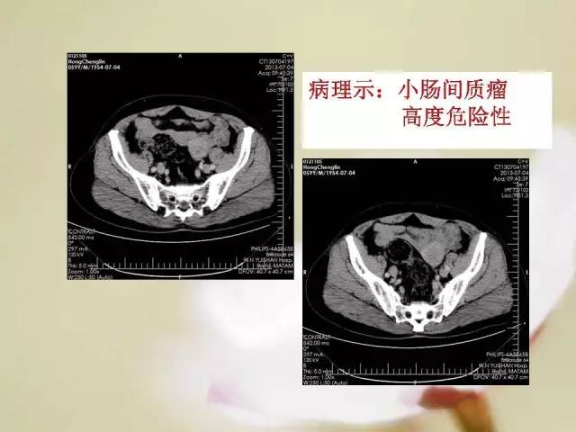 【病例】胃肠道间质瘤1例影像诊断与鉴别 【病例】胃肠道间质瘤1例影像诊断与鉴别