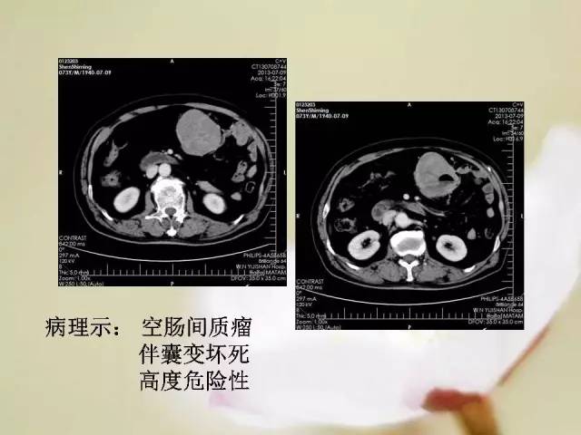 【病例】胃肠道间质瘤1例影像诊断与鉴别 【病例】胃肠道间质瘤1例影像诊断与鉴别