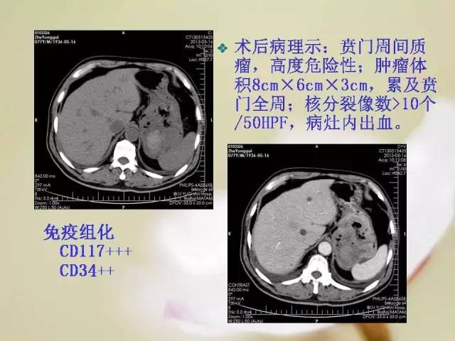 【病例】胃肠道间质瘤1例影像诊断与鉴别 【病例】胃肠道间质瘤1例影像诊断与鉴别
