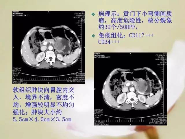 【病例】胃肠道间质瘤1例影像诊断与鉴别 【病例】胃肠道间质瘤1例影像诊断与鉴别