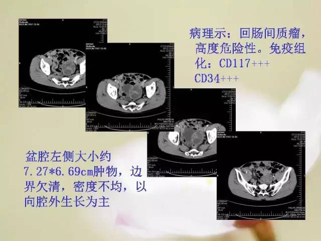 【病例】胃肠道间质瘤1例影像诊断与鉴别 【病例】胃肠道间质瘤1例影像诊断与鉴别