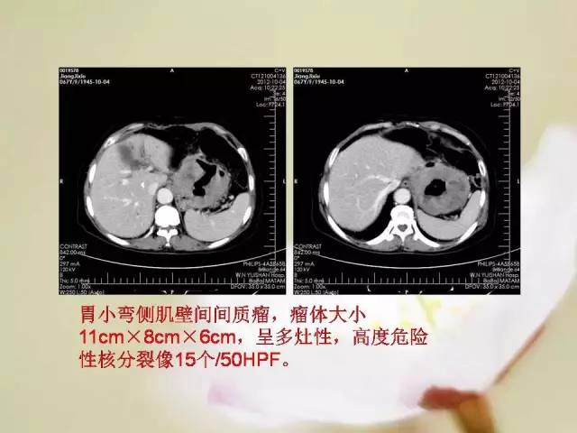 【病例】胃肠道间质瘤1例影像诊断与鉴别 【病例】胃肠道间质瘤1例影像诊断与鉴别