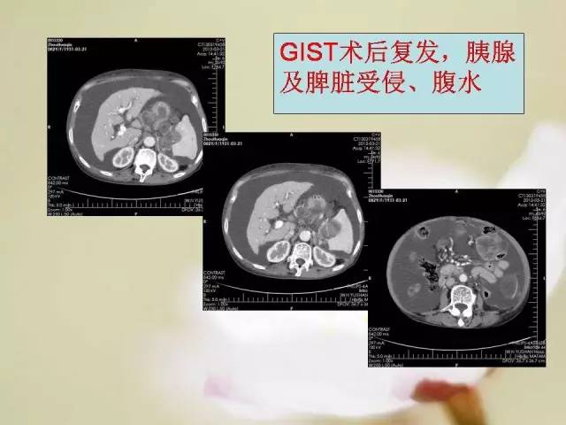 【病例】胃肠道间质瘤1例影像诊断与鉴别 【病例】胃肠道间质瘤1例影像诊断与鉴别