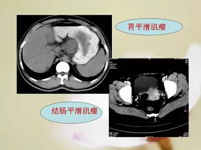 【病例】胃肠道间质瘤1例影像诊断与鉴别 【病例】胃肠道间质瘤1例影像诊断与鉴别