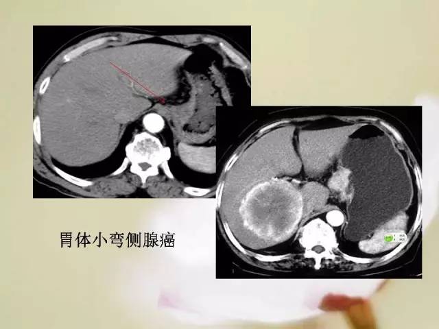 【病例】胃肠道间质瘤1例影像诊断与鉴别 【病例】胃肠道间质瘤1例影像诊断与鉴别