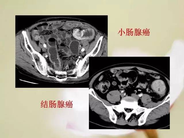 【病例】胃肠道间质瘤1例影像诊断与鉴别 【病例】胃肠道间质瘤1例影像诊断与鉴别