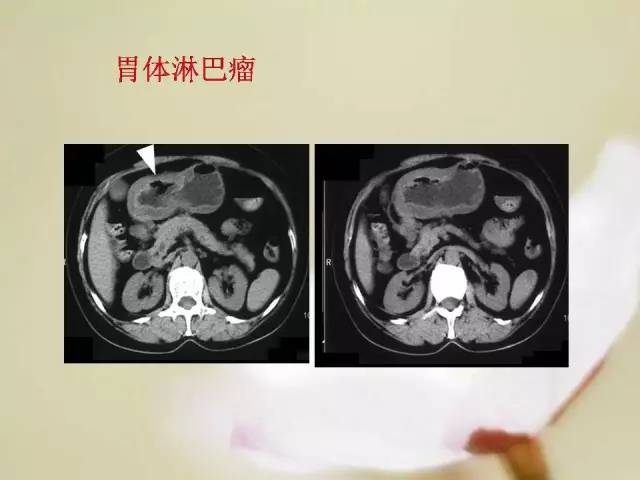 【病例】胃肠道间质瘤1例影像诊断与鉴别 【病例】胃肠道间质瘤1例影像诊断与鉴别