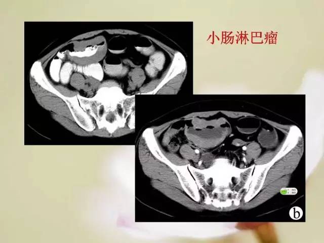 【病例】胃肠道间质瘤1例影像诊断与鉴别 【病例】胃肠道间质瘤1例影像诊断与鉴别
