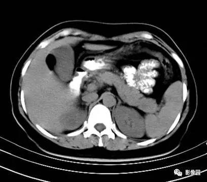 【病例】肝左叶局灶性结节增生1例CT影像表现 【病例】肝左叶局灶性结节增生1例CT影像表现