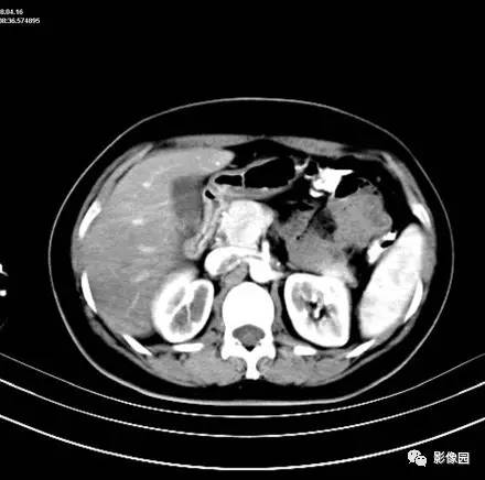 【病例】肝左叶局灶性结节增生1例CT影像表现 【病例】肝左叶局灶性结节增生1例CT影像表现