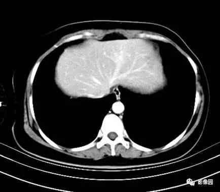 【病例】肝左叶局灶性结节增生1例CT影像表现 【病例】肝左叶局灶性结节增生1例CT影像表现