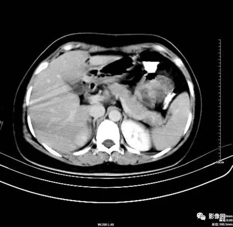 【病例】肝左叶局灶性结节增生1例CT影像表现 【病例】肝左叶局灶性结节增生1例CT影像表现