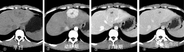 【病例】肝左叶局灶性结节增生1例CT影像表现 【病例】肝左叶局灶性结节增生1例CT影像表现