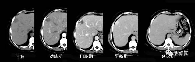 【病例】肝左叶局灶性结节增生1例CT影像表现 【病例】肝左叶局灶性结节增生1例CT影像表现