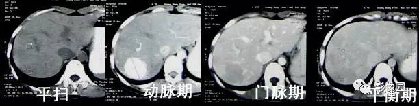 【病例】肝左叶局灶性结节增生1例CT影像表现 【病例】肝左叶局灶性结节增生1例CT影像表现