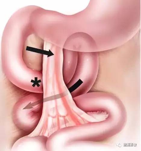 腹内疝的分型,你了解吗? 腹内疝的分型,你了解吗?