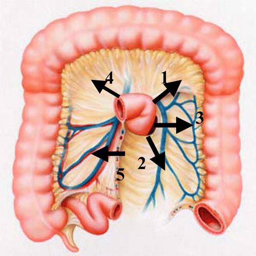 腹内疝的分型,你了解吗? 腹内疝的分型,你了解吗?