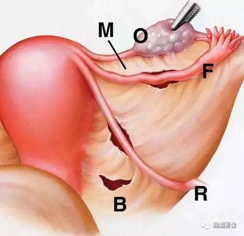 腹内疝的分型,你了解吗? 腹内疝的分型,你了解吗?
