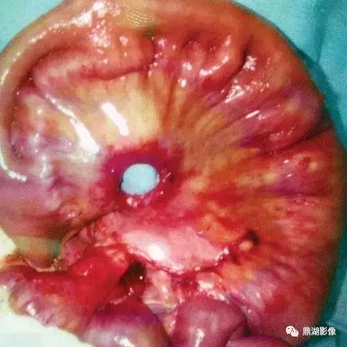 腹内疝的分型,你了解吗? 腹内疝的分型,你了解吗?