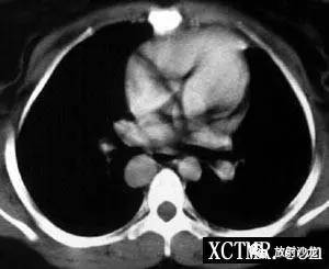 【病例】多脾综合症1例CT影像表现
