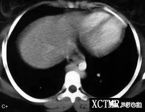 【病例】多脾综合症1例CT影像表现 【病例】多脾综合症1例CT影像表现