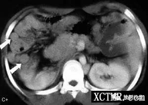 【病例】多脾综合症1例CT影像表现